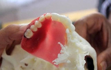 Жителю Индии сделали новую челюсть на 3D-принтере