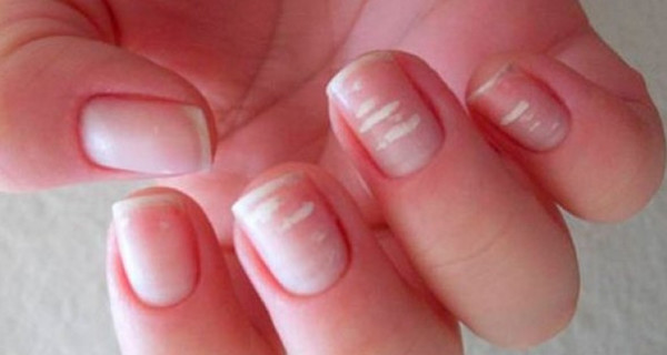 Белые пятна на ногтях: почему появляются и нужно ли лечить
