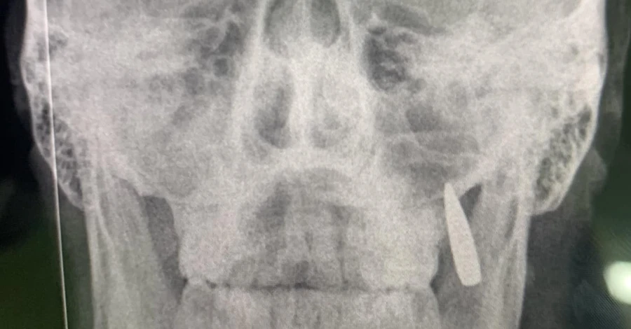 Лікарі допомогли бійцю ЗСУ, у якого в зубах застрягла куля